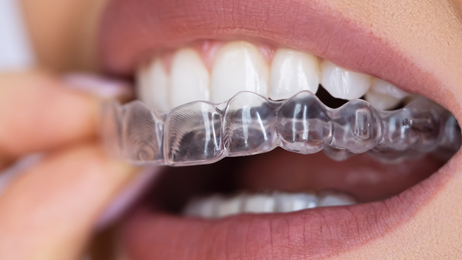 $1,000 Off Orthodontic Treatment