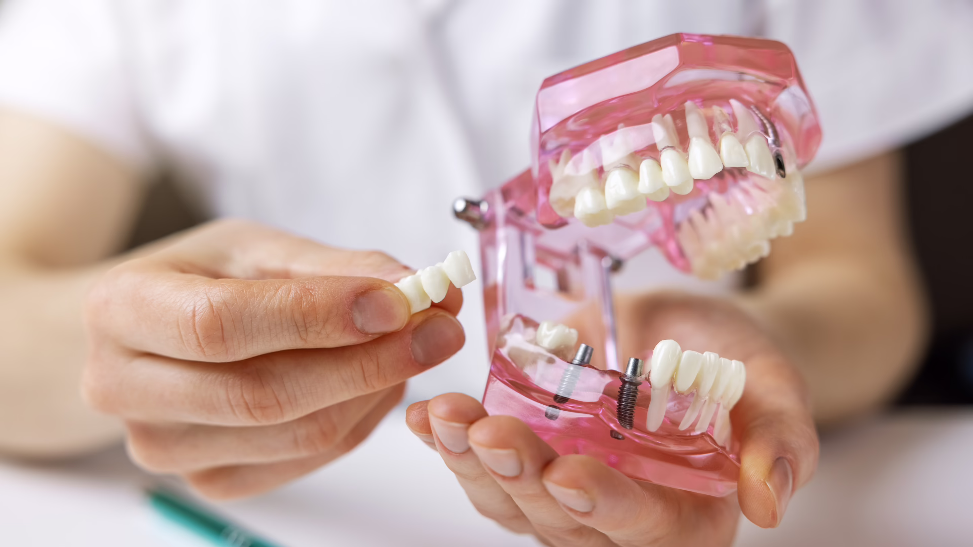 FREE Implant Consultation