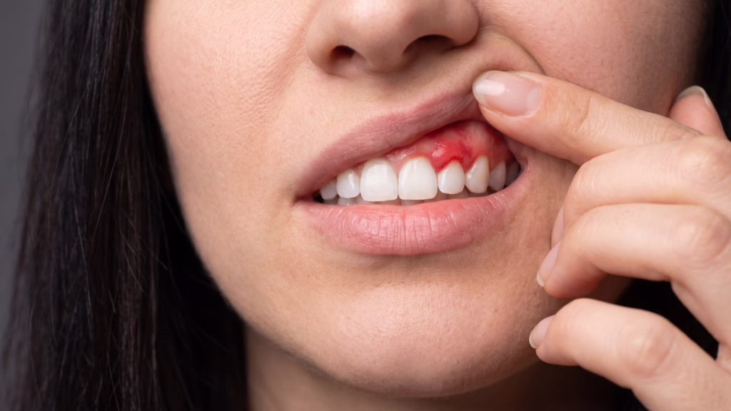 Is Gum Disease Reversible?