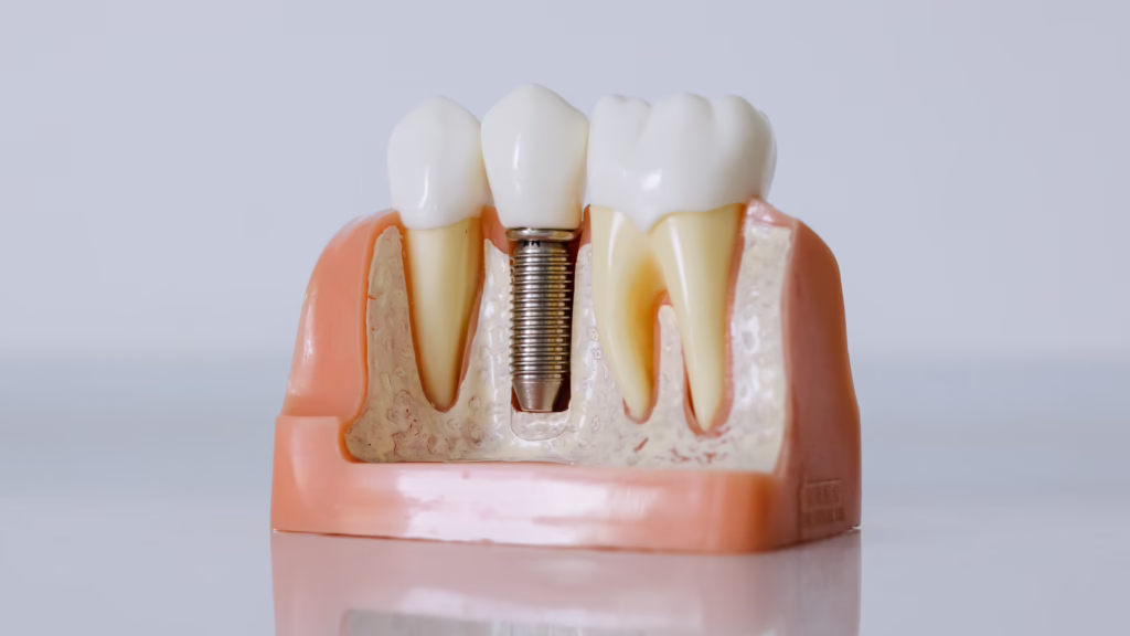 Are Dental Implants Worth It?