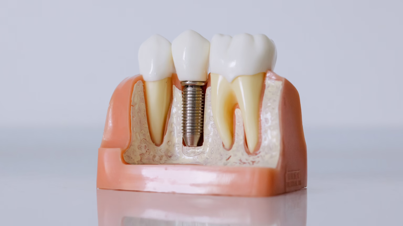 Are Dental Implants Worth It?