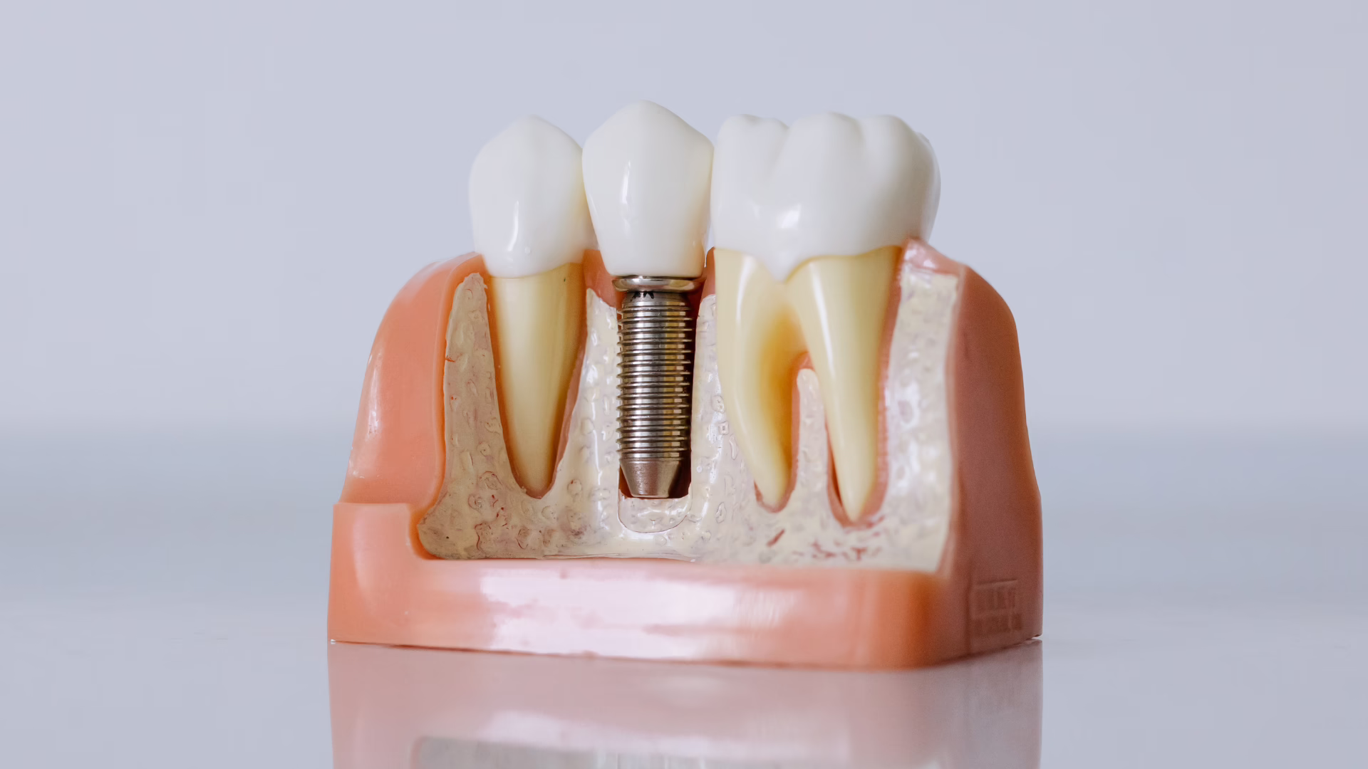 Are Dental Implants Worth It?